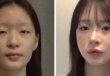 Estetik ameliyatı öncesi ve sonrası farkı